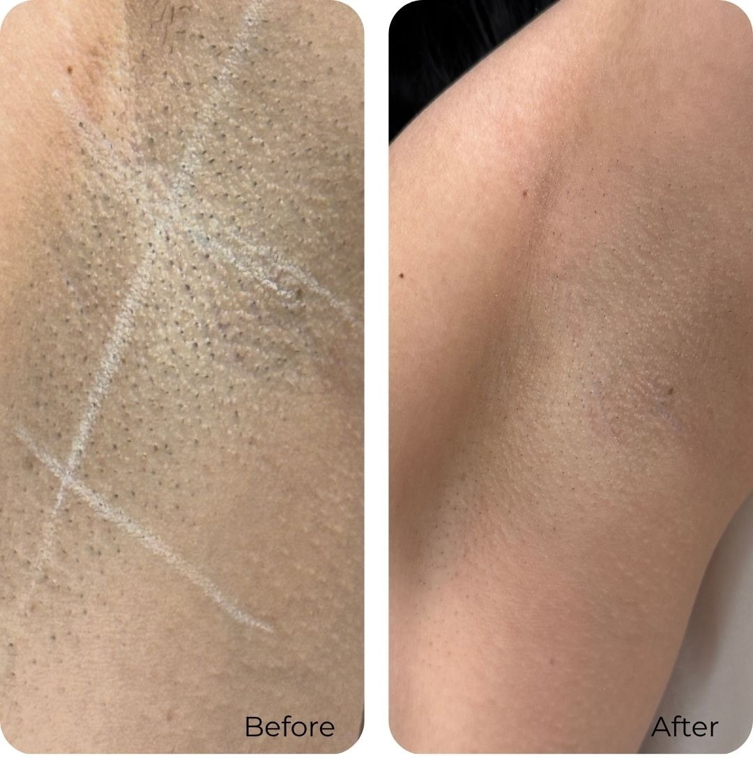 Before and after laser hair removal at Luma Skin NYC — real client result
