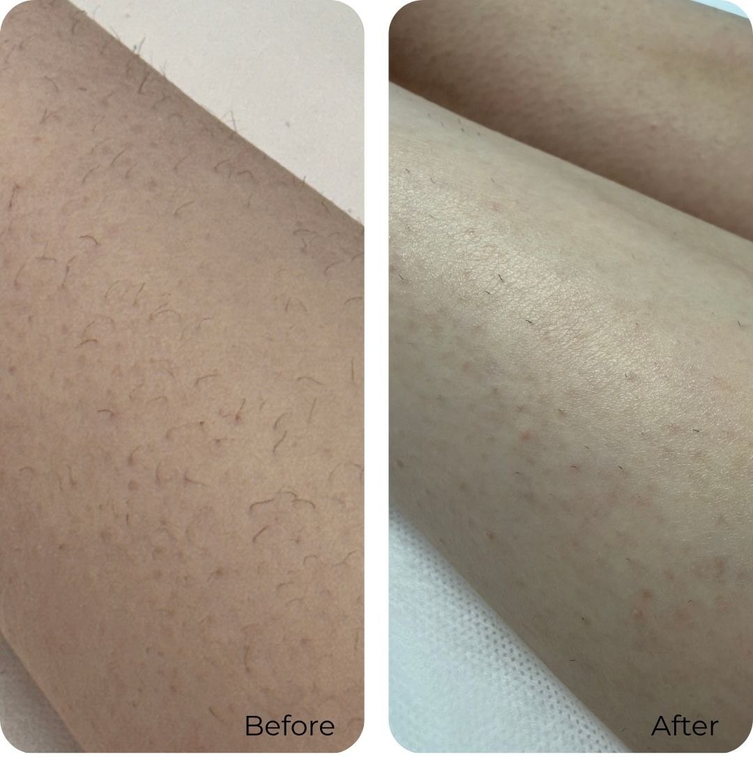 Before and after laser hair removal at Luma Skin NYC — real client result