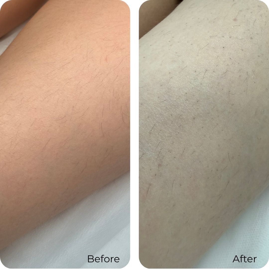Before and after laser hair removal at Luma Skin NYC — real client result