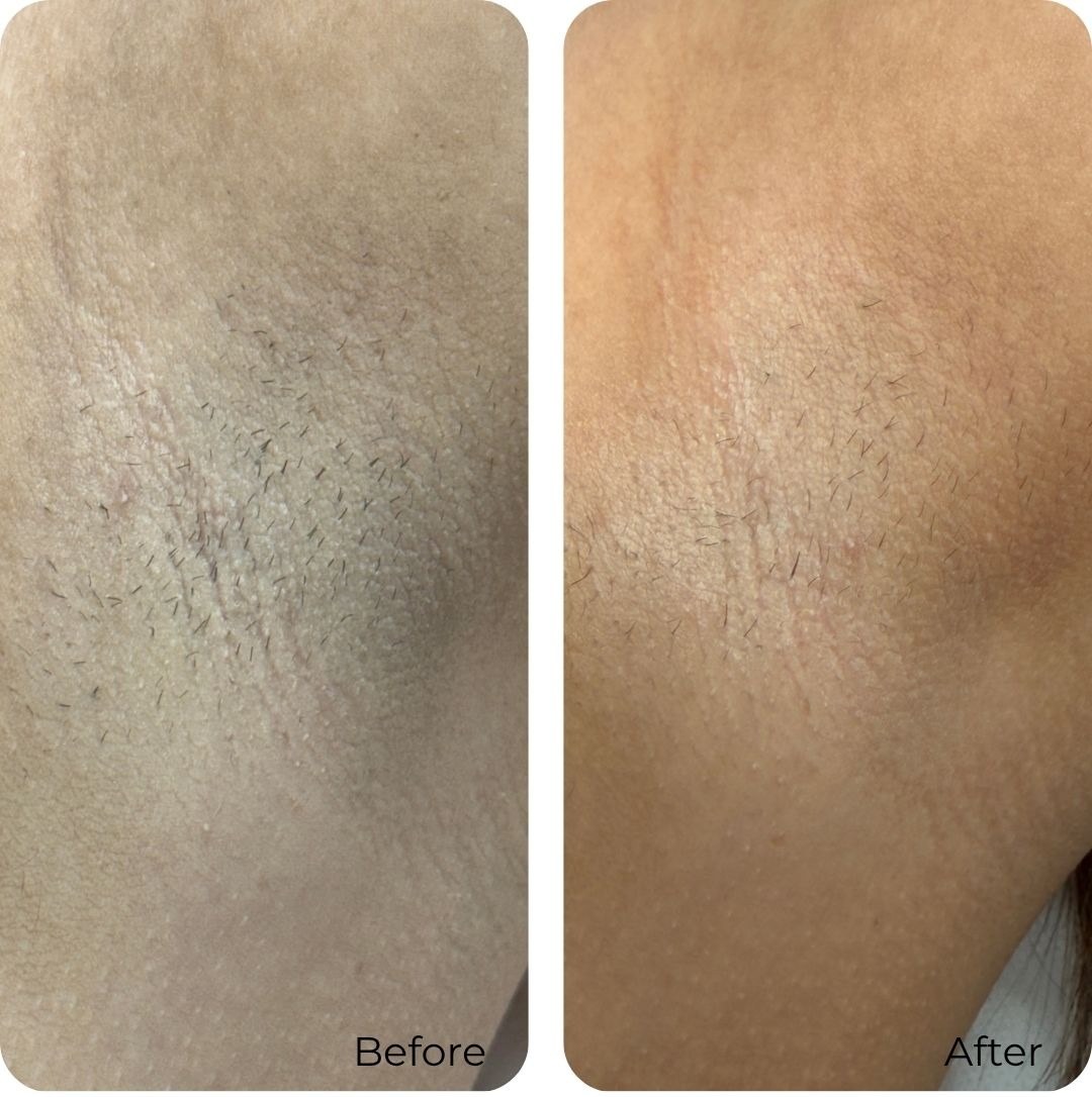 Before and after laser hair removal at Luma Skin NYC — real client result