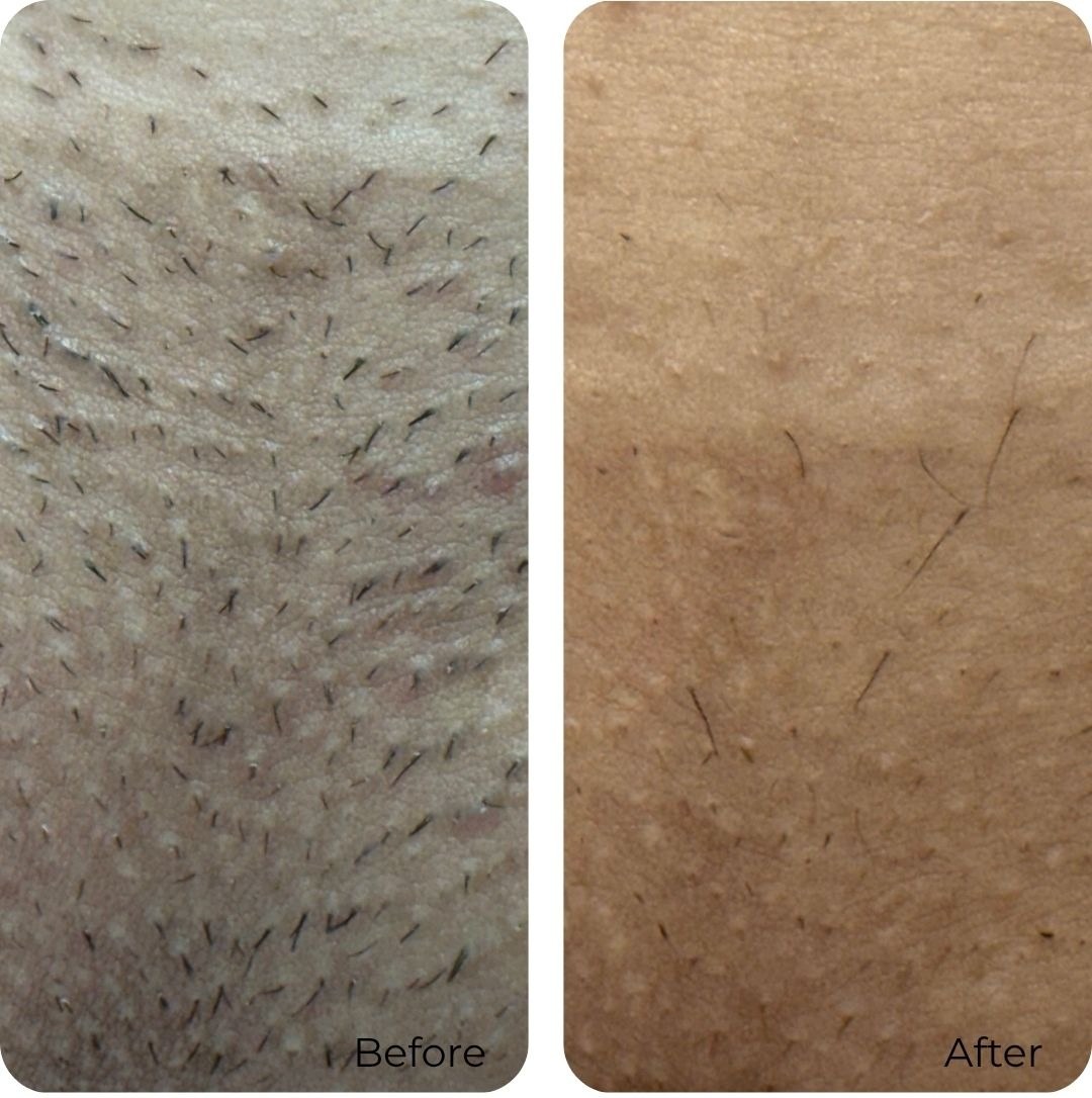 Before and after laser hair removal at Luma Skin NYC — real client result