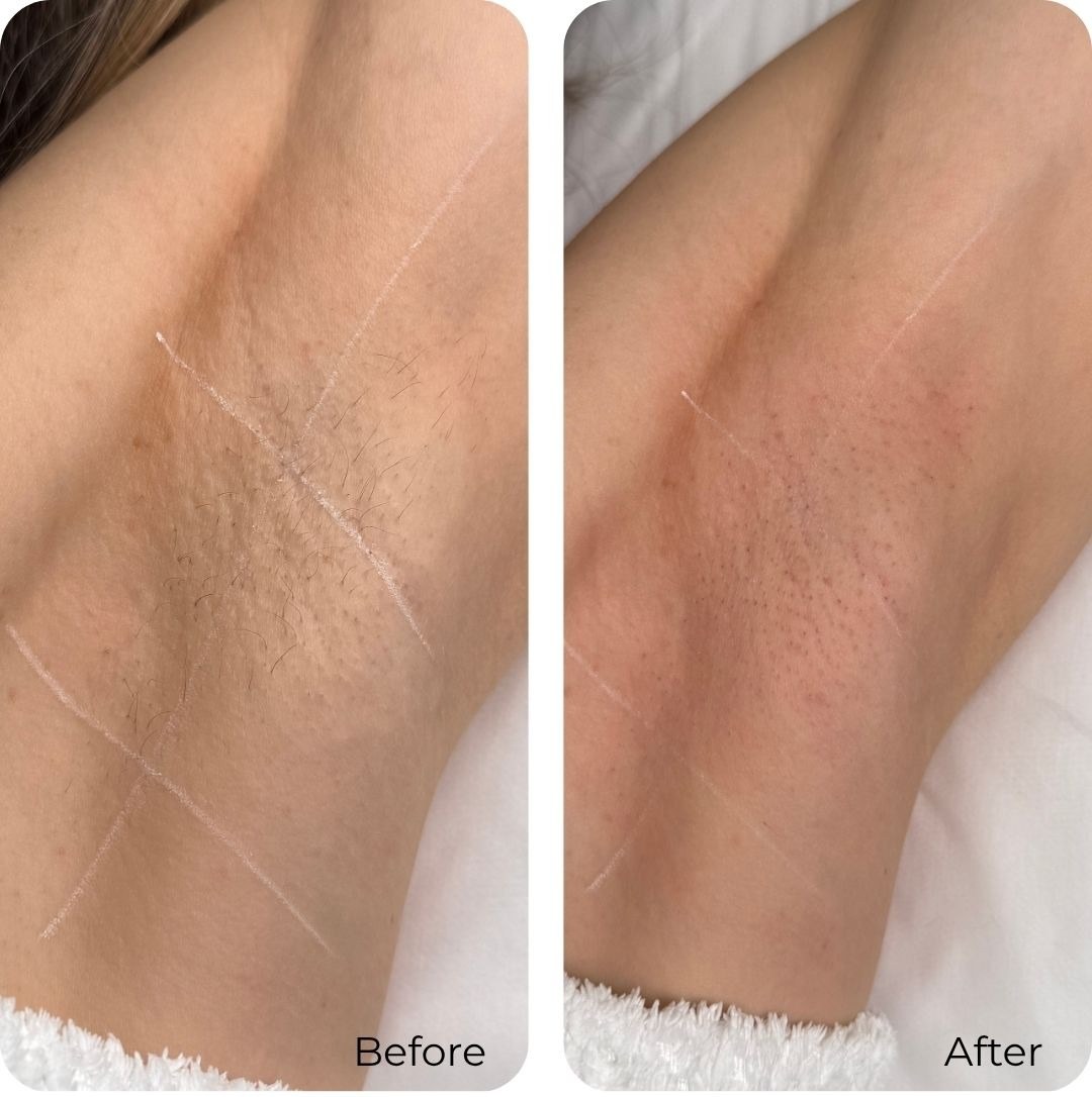 Before and after laser hair removal at Luma Skin NYC — real client result